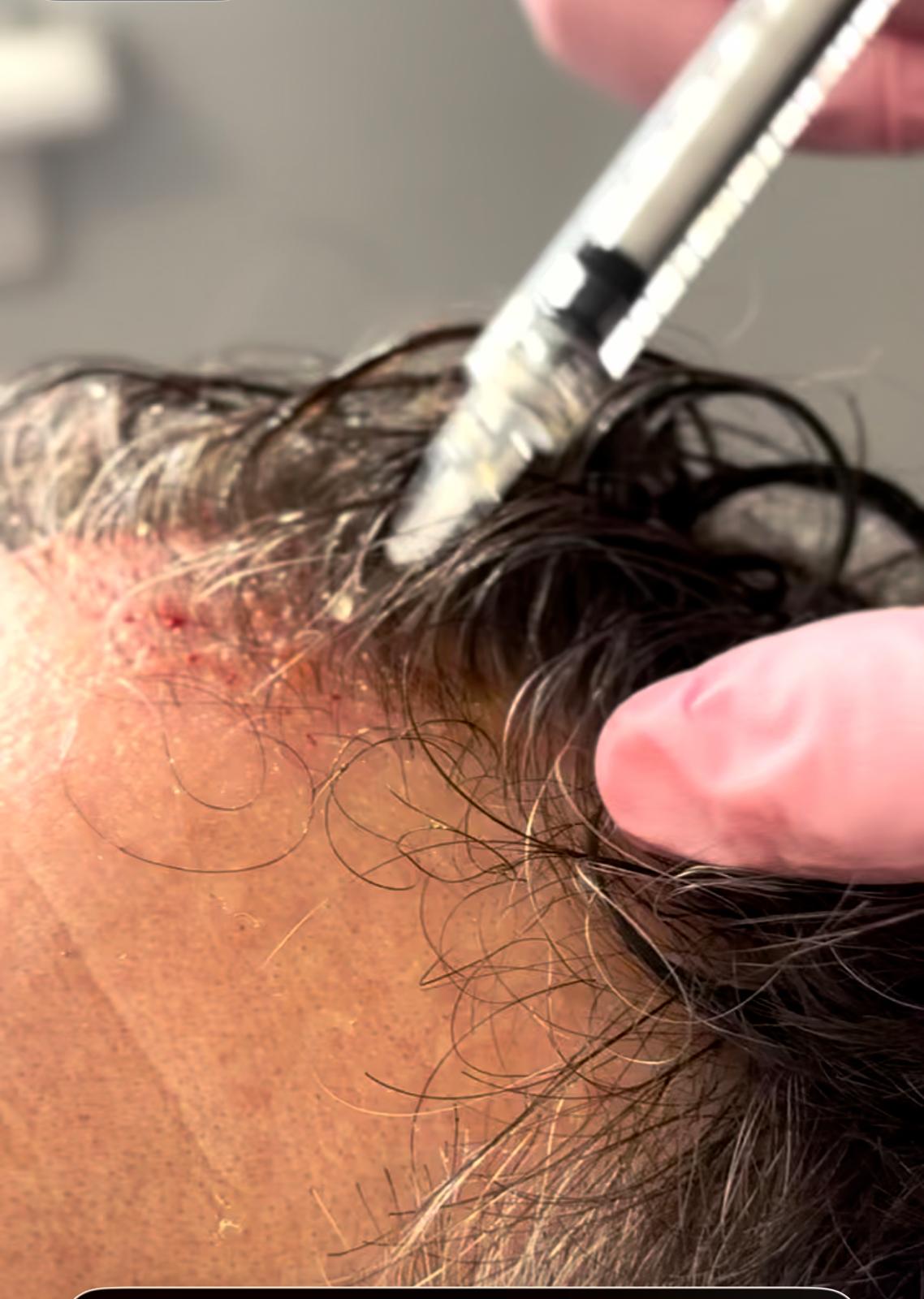 PRP vs PRF in Kanata: Which Treatment is More Effective for Skin and Hair? 2 - Medical Aesthetics and Wellness prp